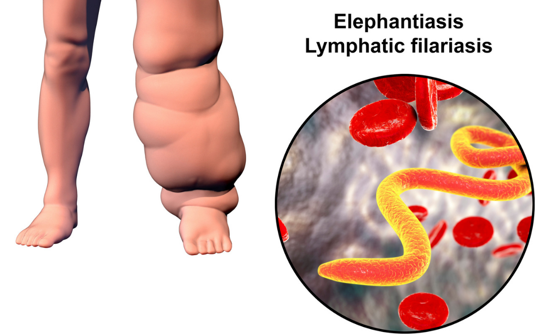 What is lymphoedema?